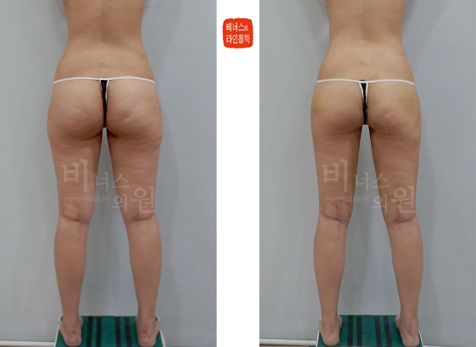 Cylindrical thighs and buttocks liposuction before-and-after photo, first case, back view (1 week after surgery)