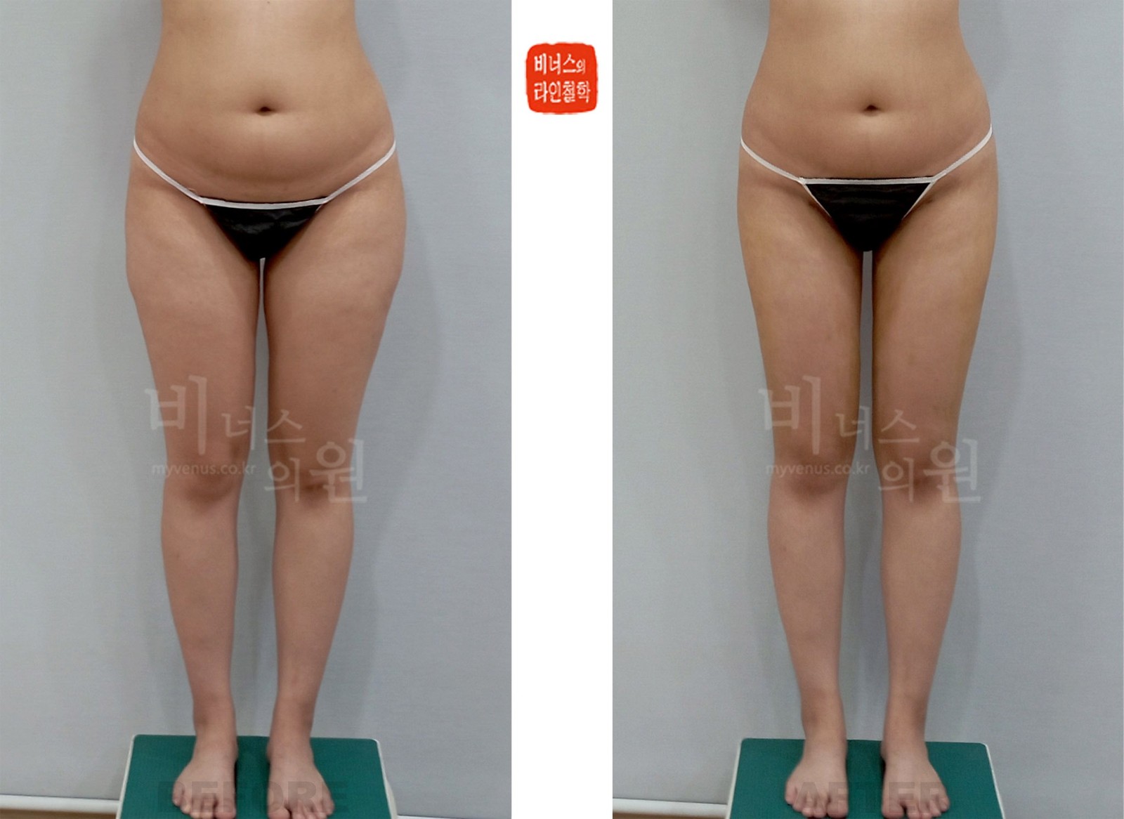 Cylindrical thighs and buttocks liposuction before-and-after photo, first case, front view (1 week after surgery)