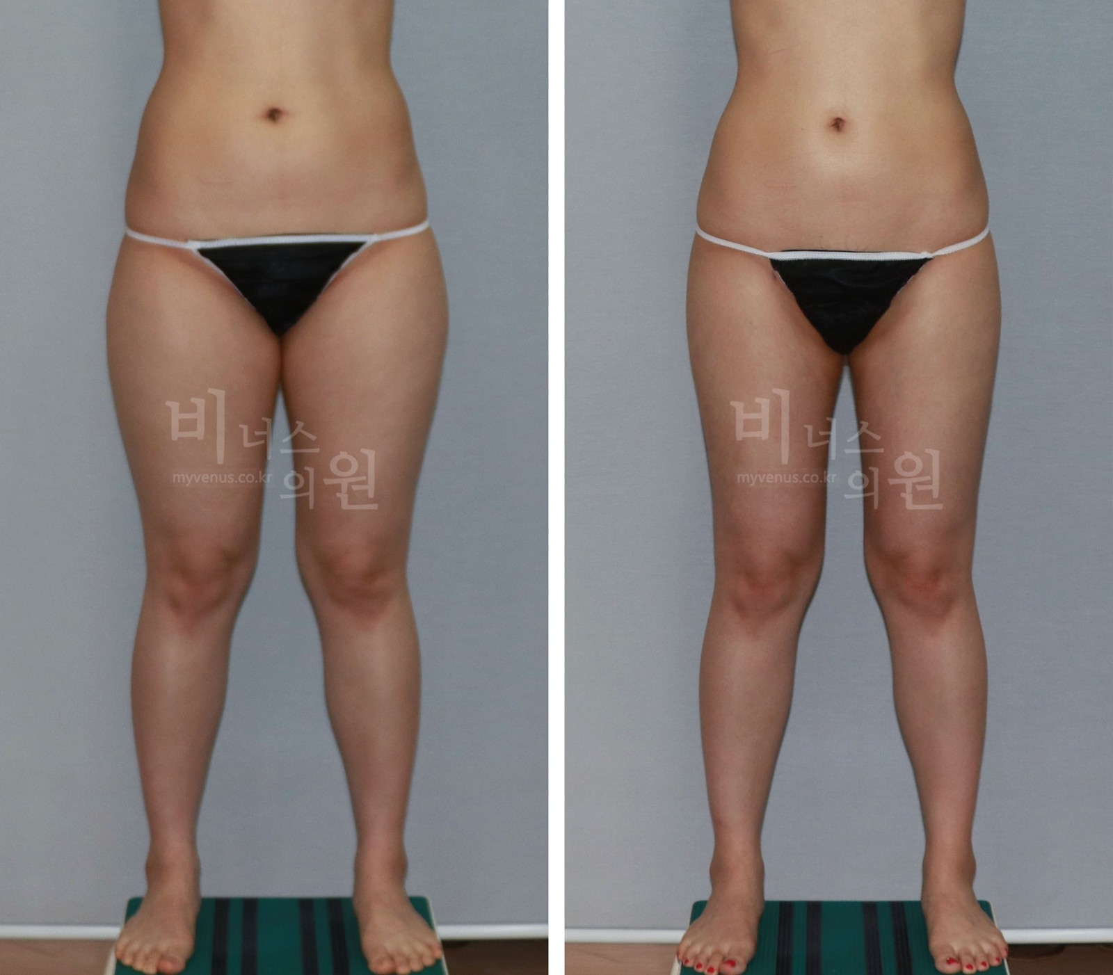 Cylindrical thighs liposuction before-and-after photo, second case, front view (3 months after surgery)