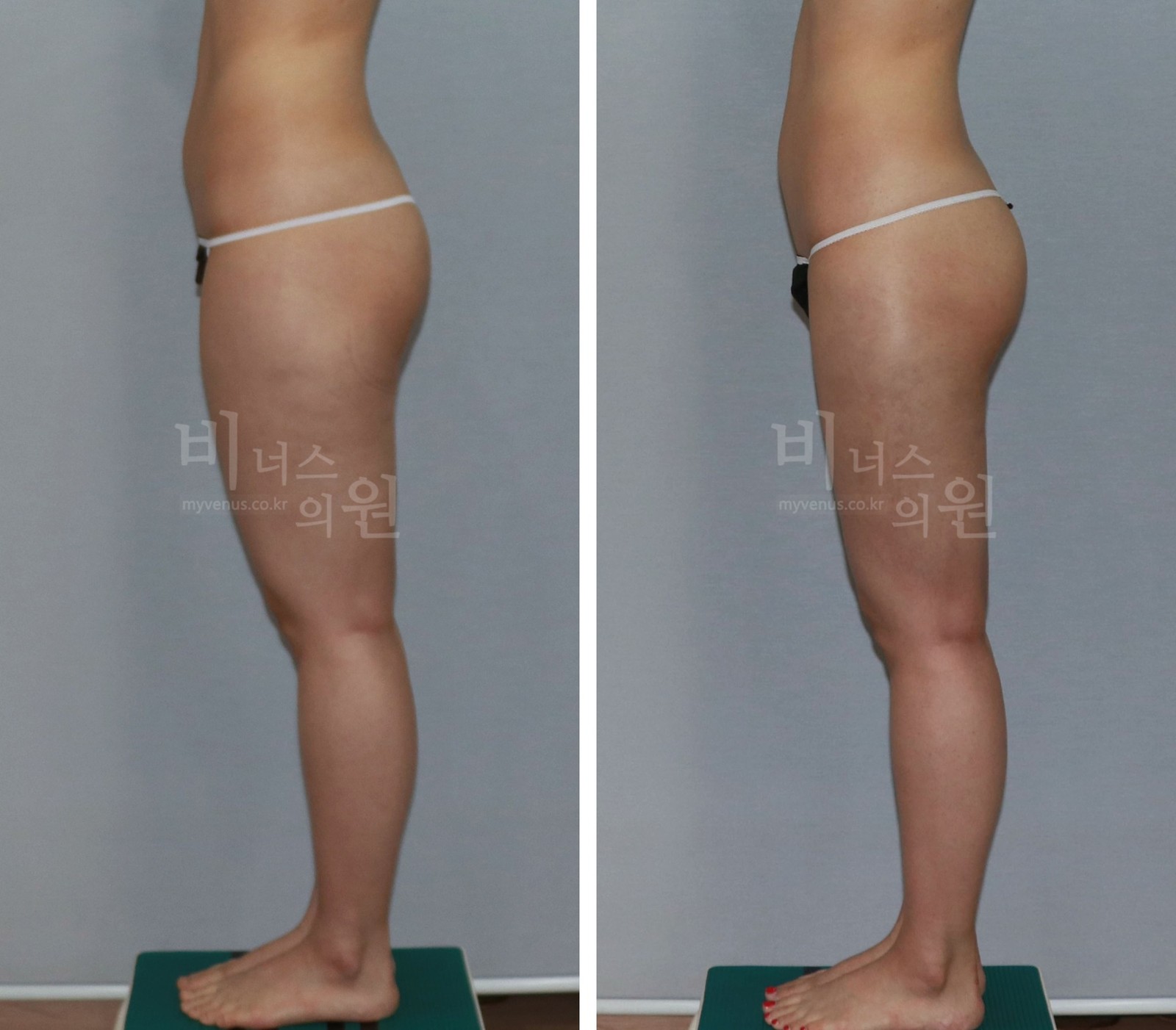 Cylindrical thighs liposuction before-and-after photo, second case, left side view (3 months after surgery)