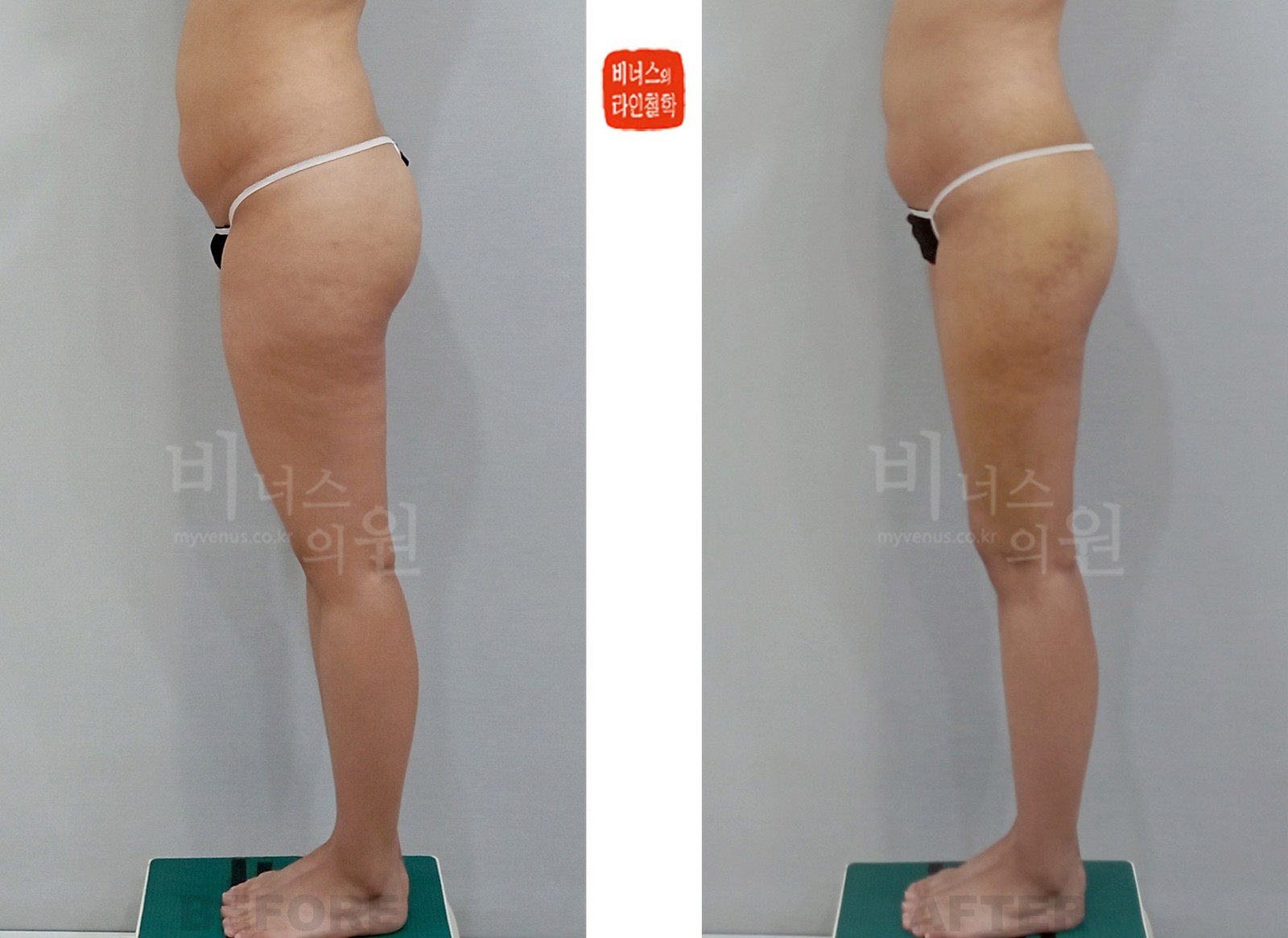 Cylindrical thighs and buttocks liposuction before-and-after photo, first case, left side view (1 week after surgery)