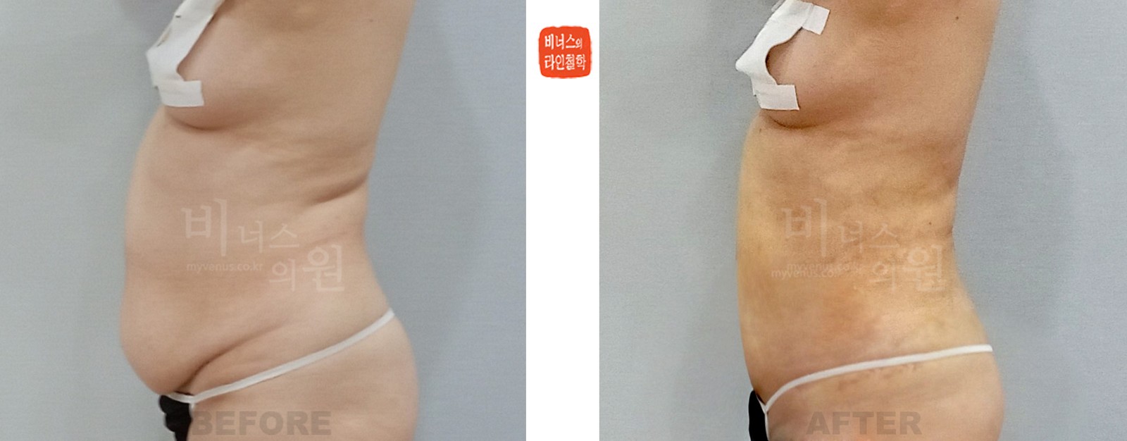 Abdominal liposuction before-and-after, side view (1 week after surgery)
