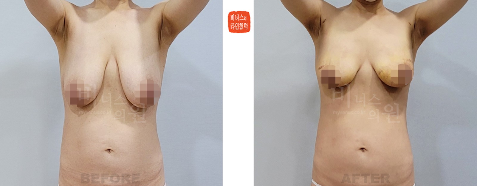 Breast liposuction before-and-after, front view (1 week after surgery)