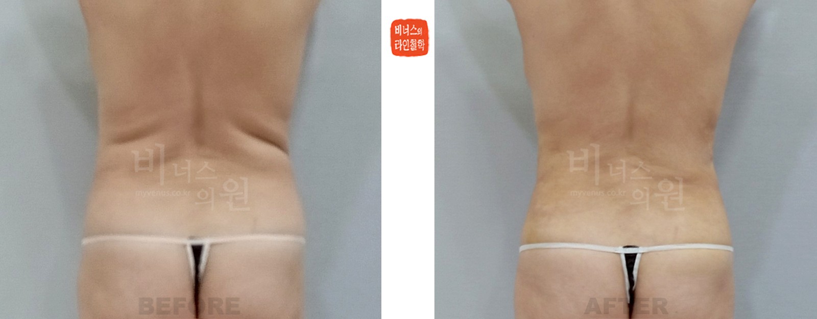 Abdominal liposuction before-and-after, rear view (1 week after surgery)