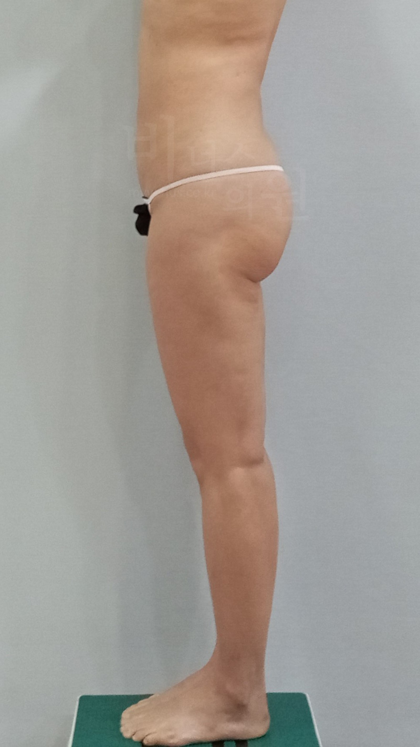 Before buttock liposuction, side view
