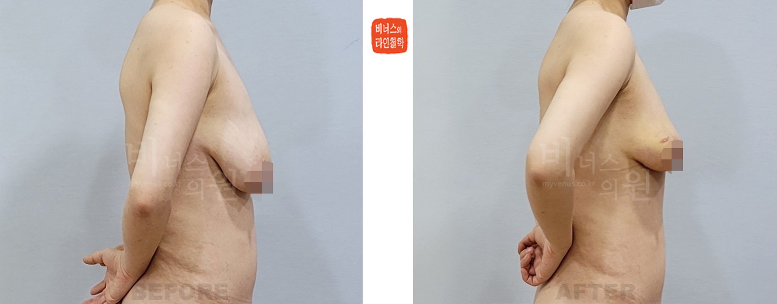 Breast liposuction before-and-after, side view (1 week after surgery)