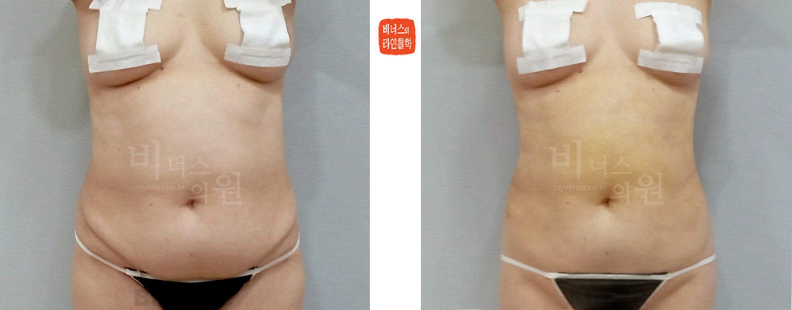 Abdominal liposuction before-and-after, front view (1 week after surgery)