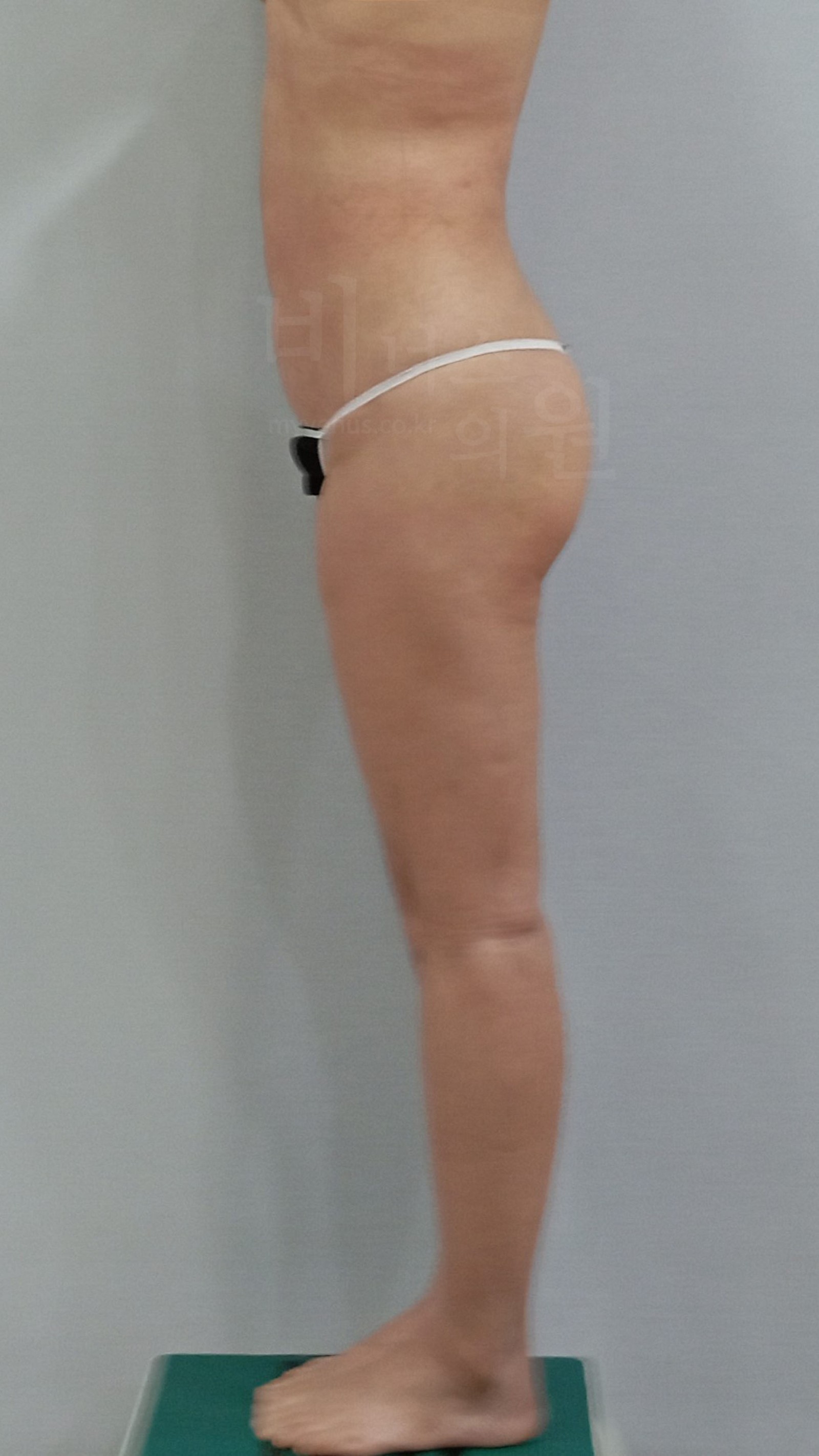 One week after buttock liposuction, side view