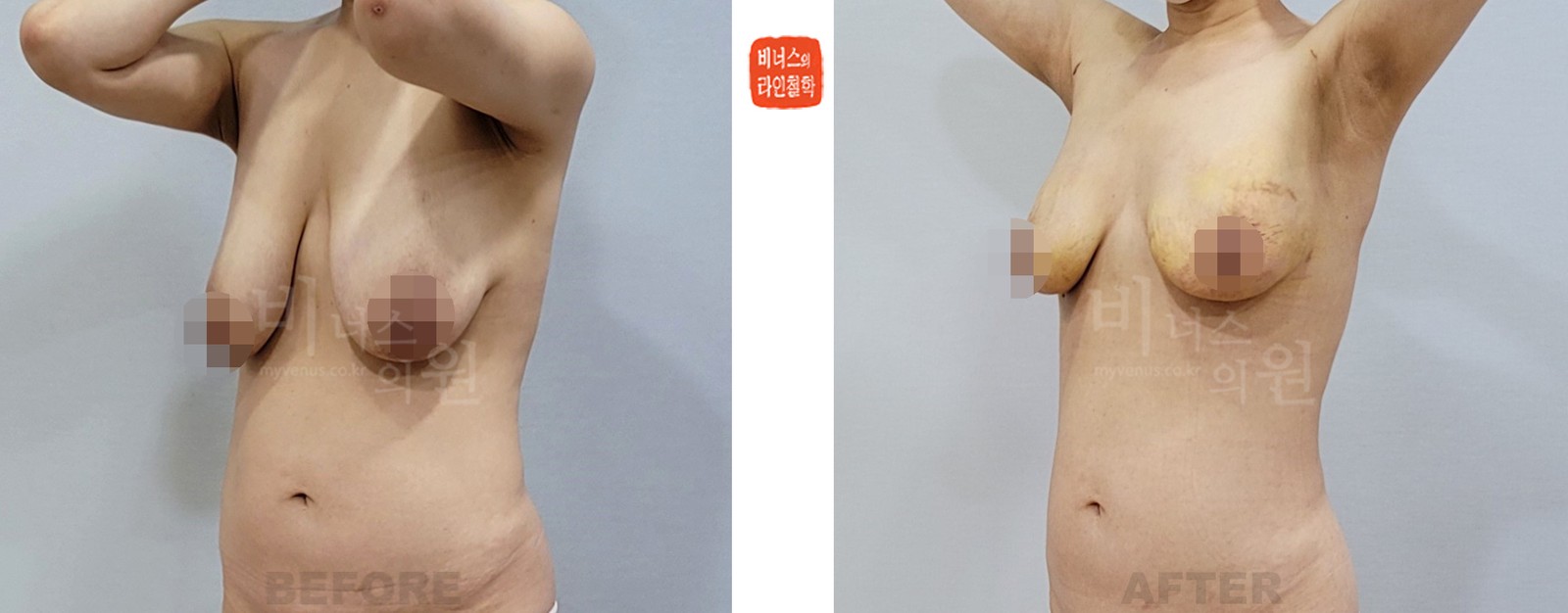 Breast liposuction before-and-after, 45-degree side view (1 week after surgery)
