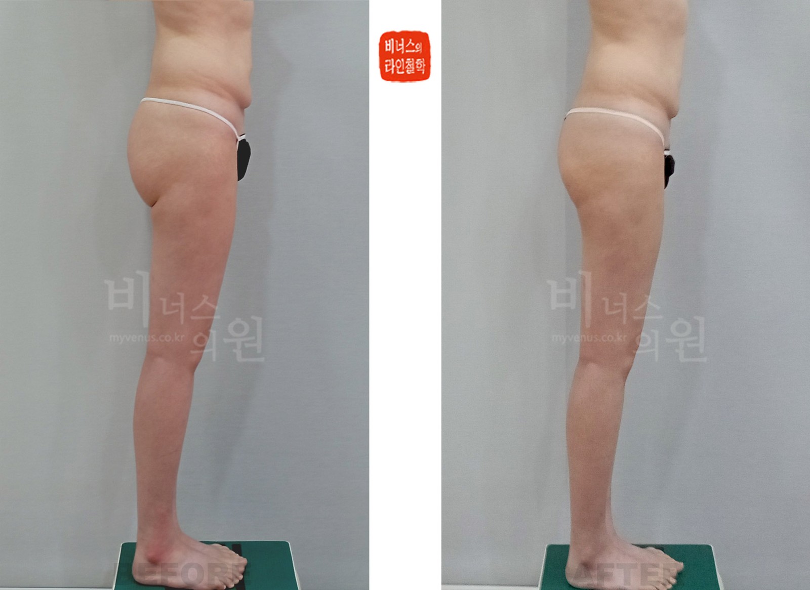 Before-and-after photos of buttock liposuction and fat grafting for a double thigh crease, right side view (1 week after surgery)