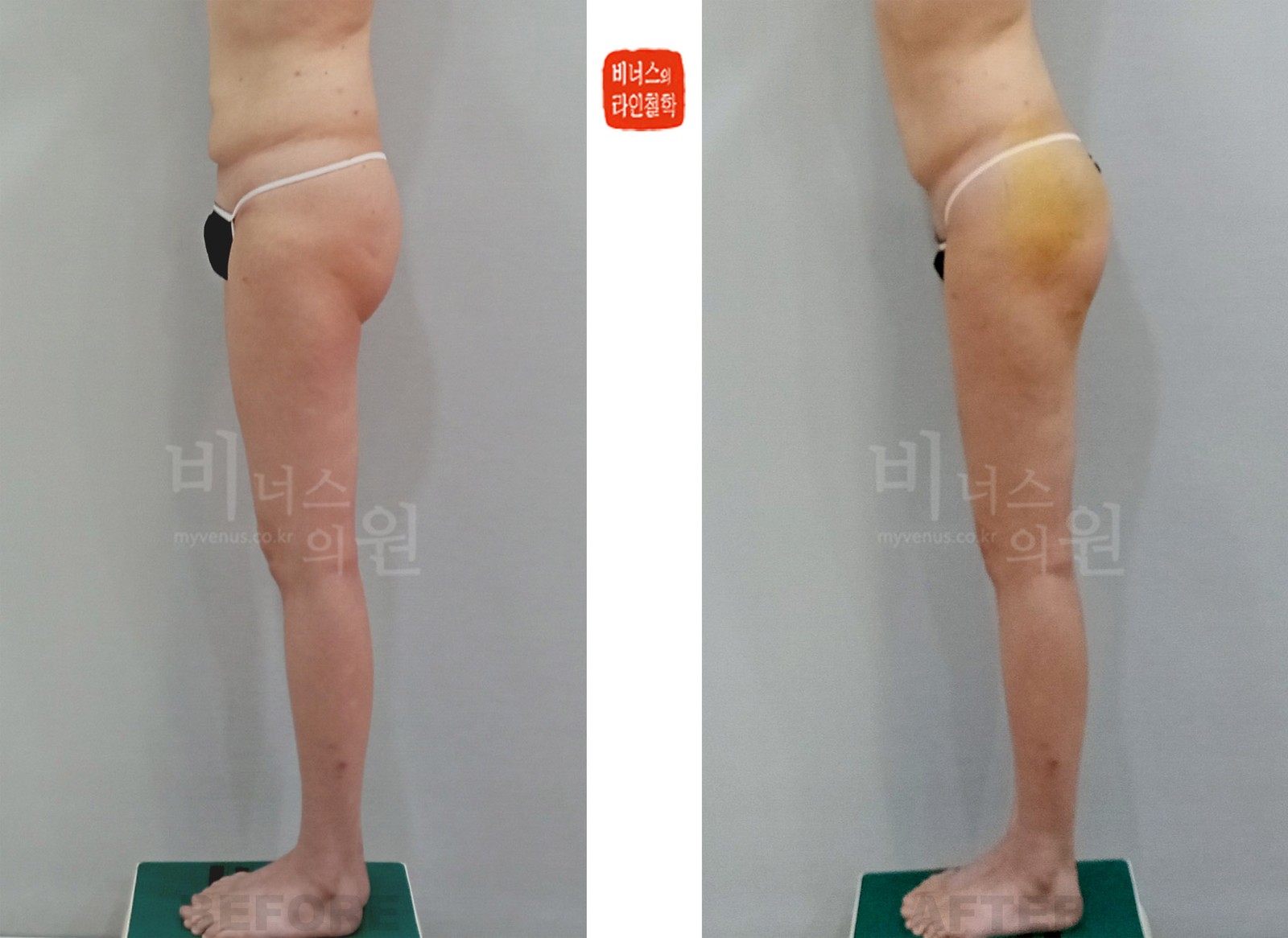 Before-and-after photos of buttock liposuction and fat grafting for a double thigh crease, left side view (1 week after surgery)