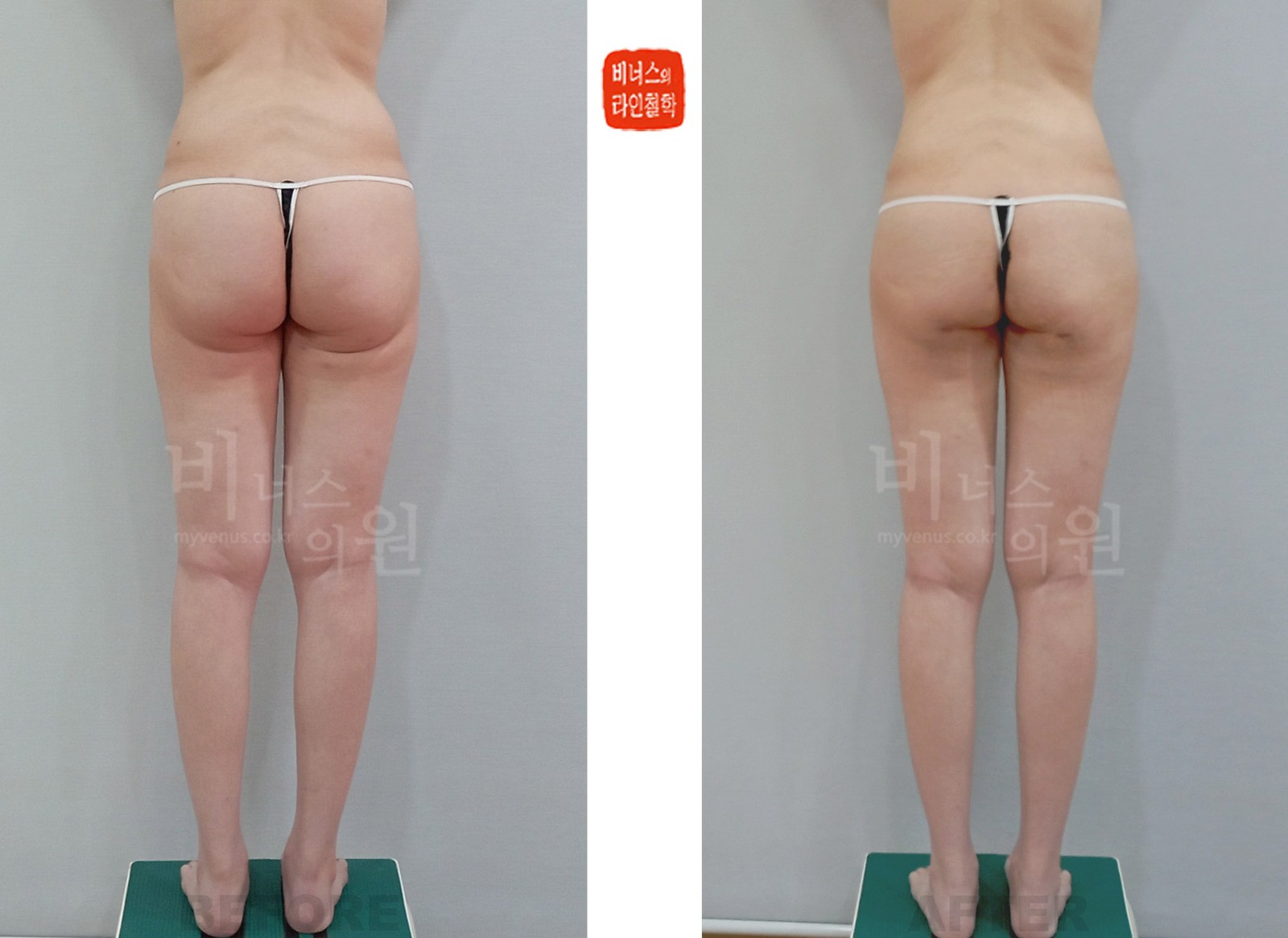 Before-and-after photos of buttock liposuction and fat grafting for a double thigh crease, rear view (1 week after surgery)