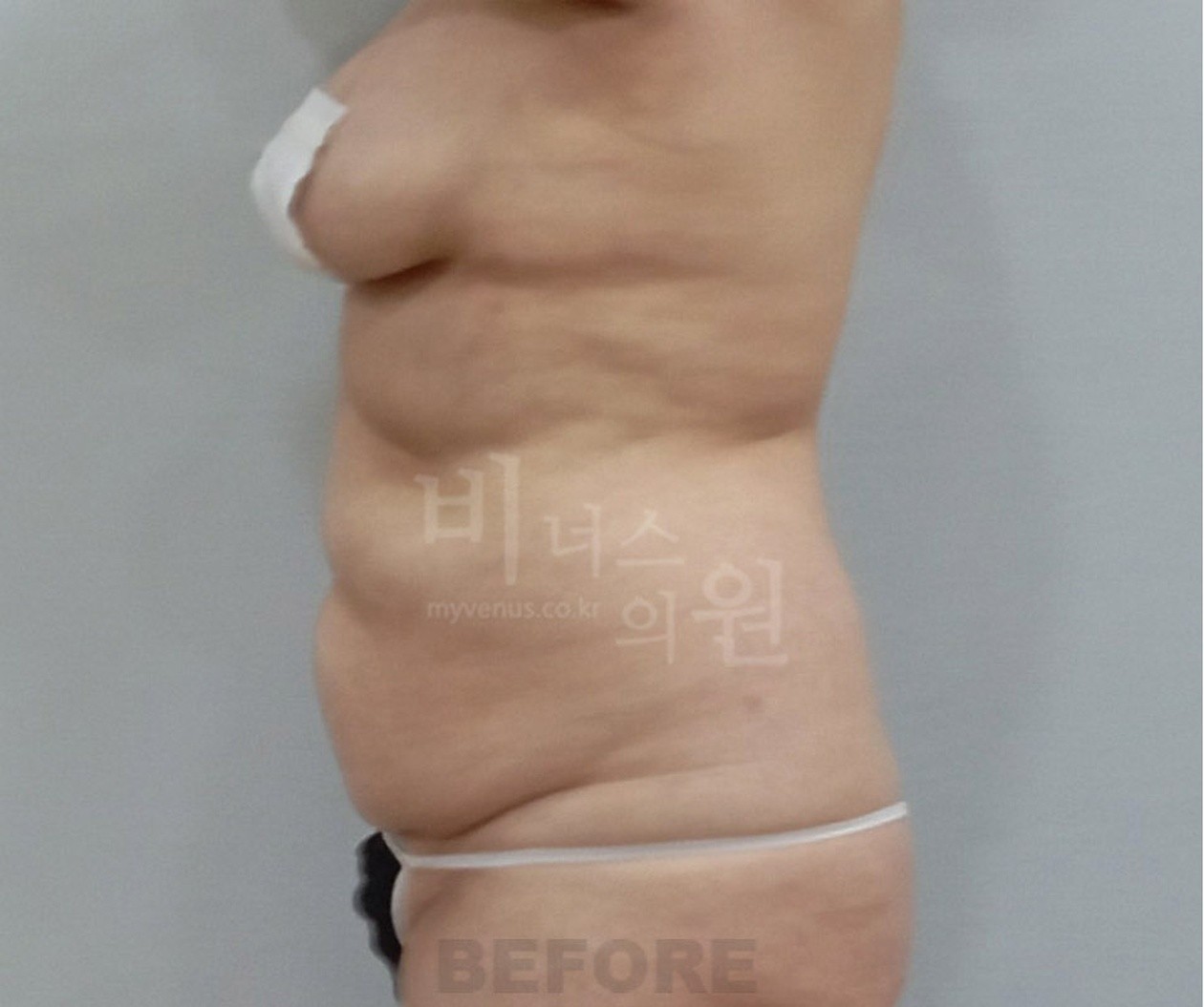 Side view before abdominal liposuction