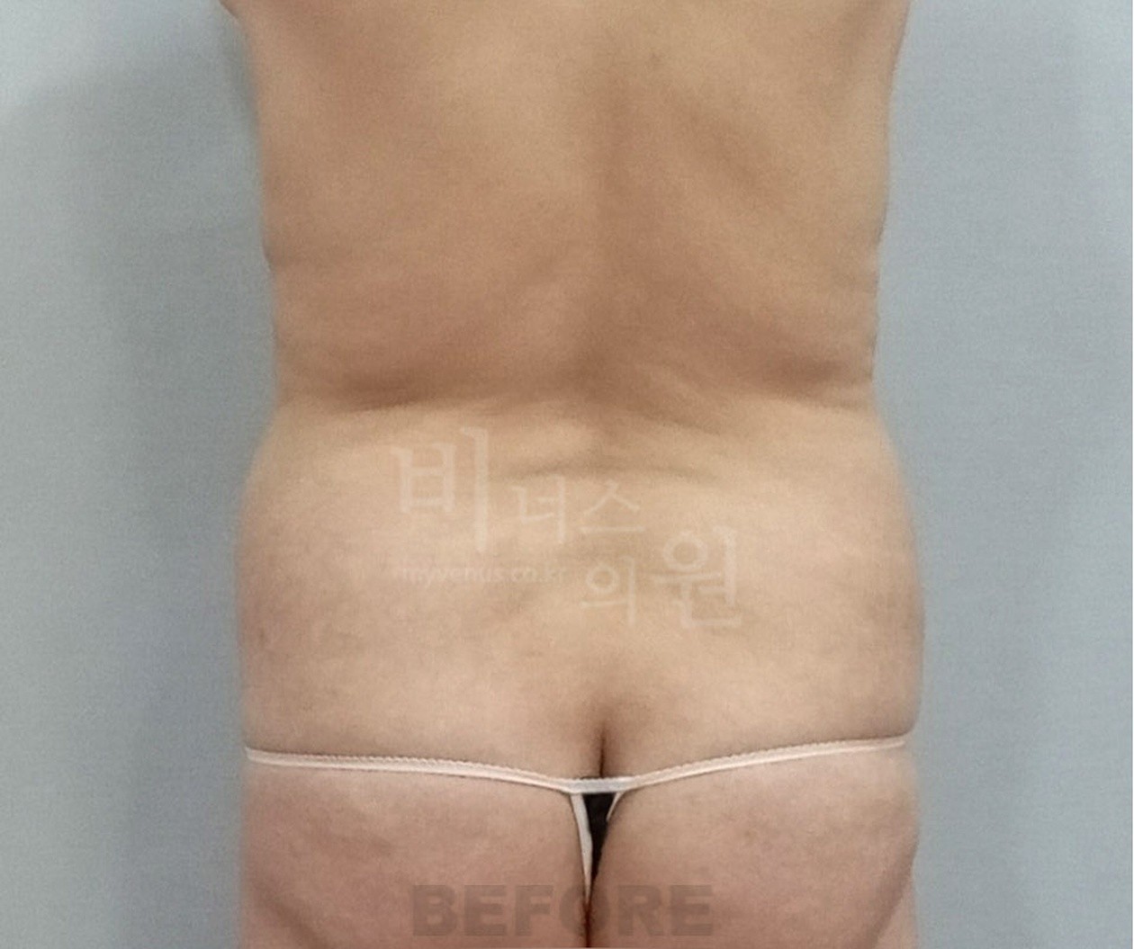 Back view before abdominal liposuction