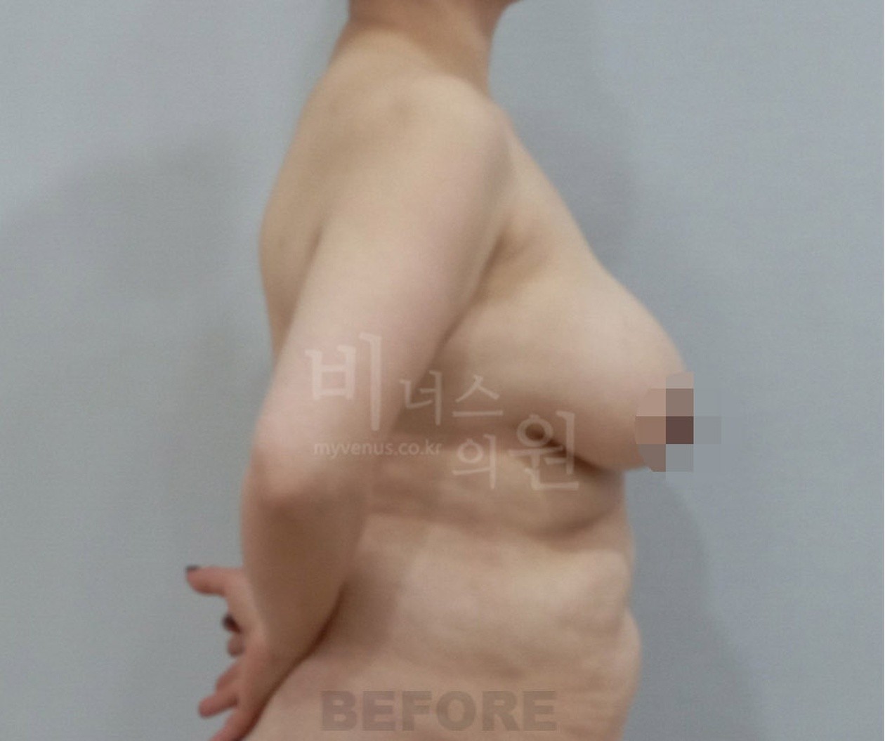 Side view before breast liposuction