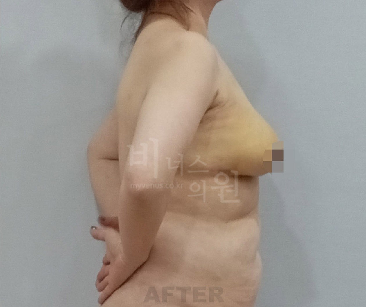Side view after breast liposuction