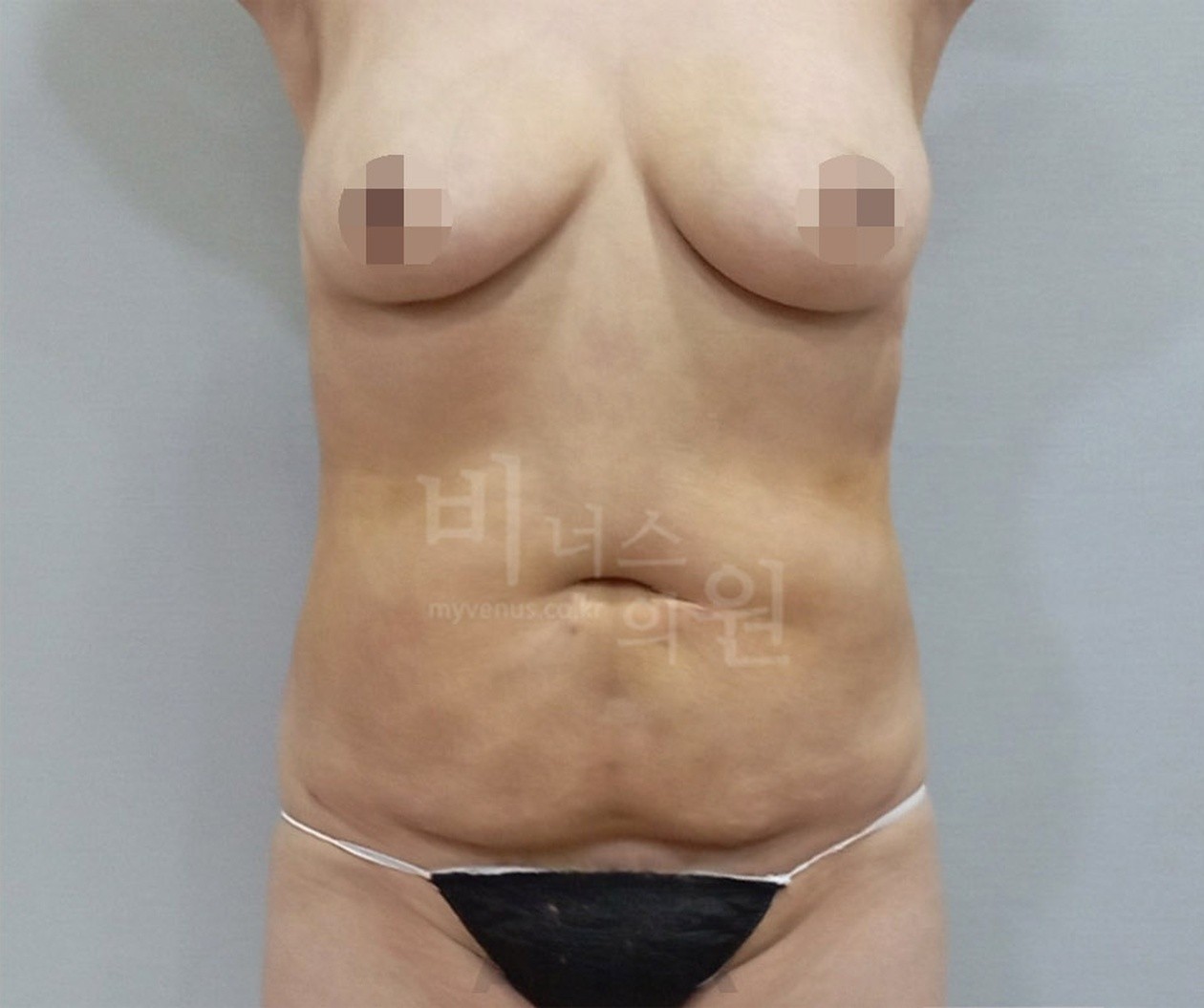 Front view after abdominal liposuction