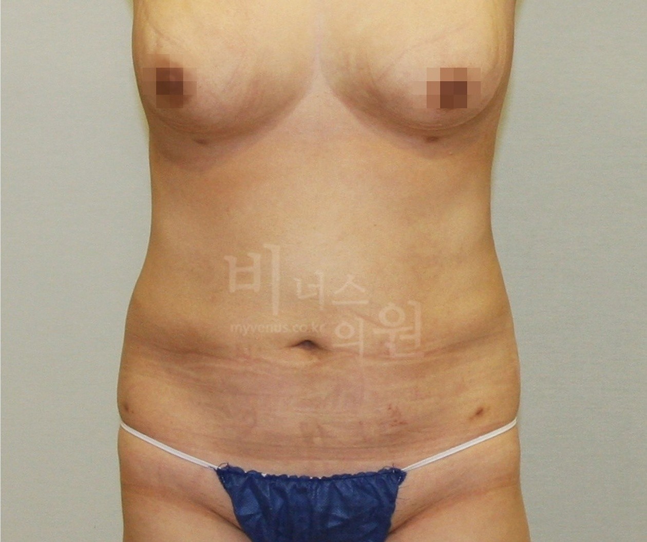 Front view after abdominal liposuction (taken in 2012)