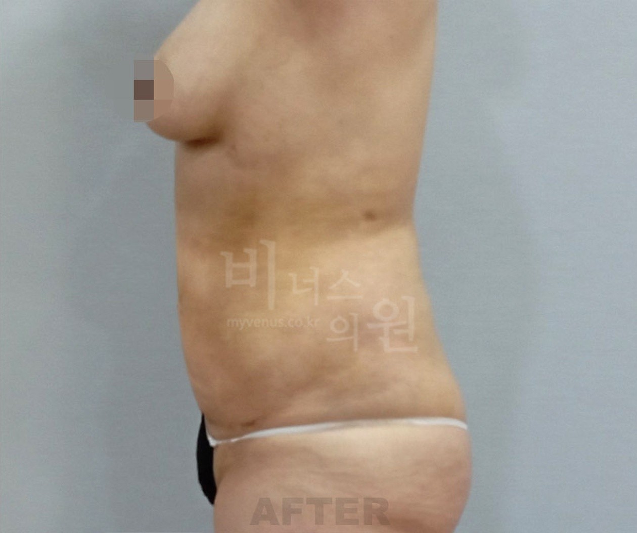 Side view after abdominal liposuction