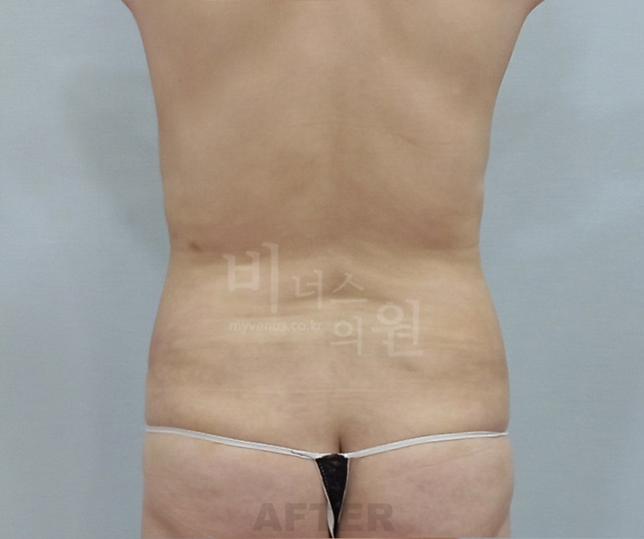 Back view after abdominal liposuction
