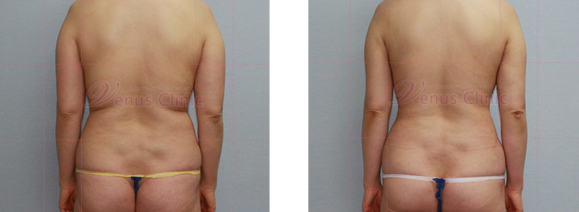 Liposuction of the back and waist 1