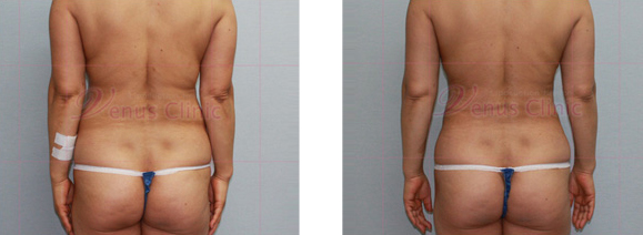 Liposuction of the back and waist 2