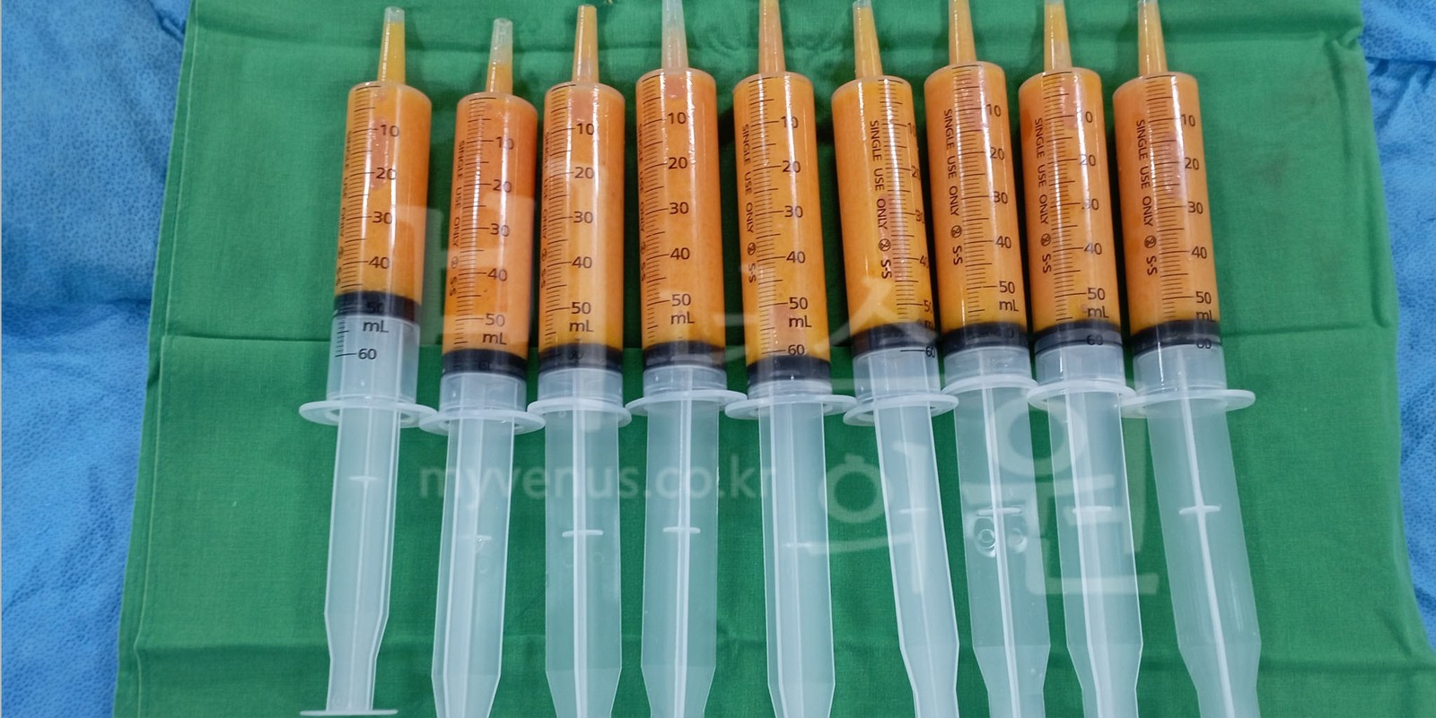 Nine 60 mL syringes containing fat harvested by syringe liposuction