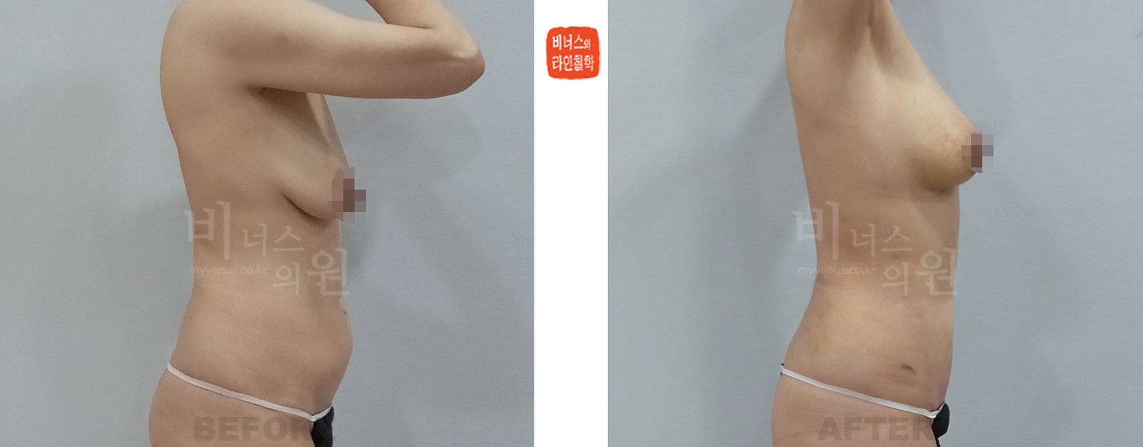 Before and after abdominal liposuction and breast fat grafting, right side view (1 week after surgery)