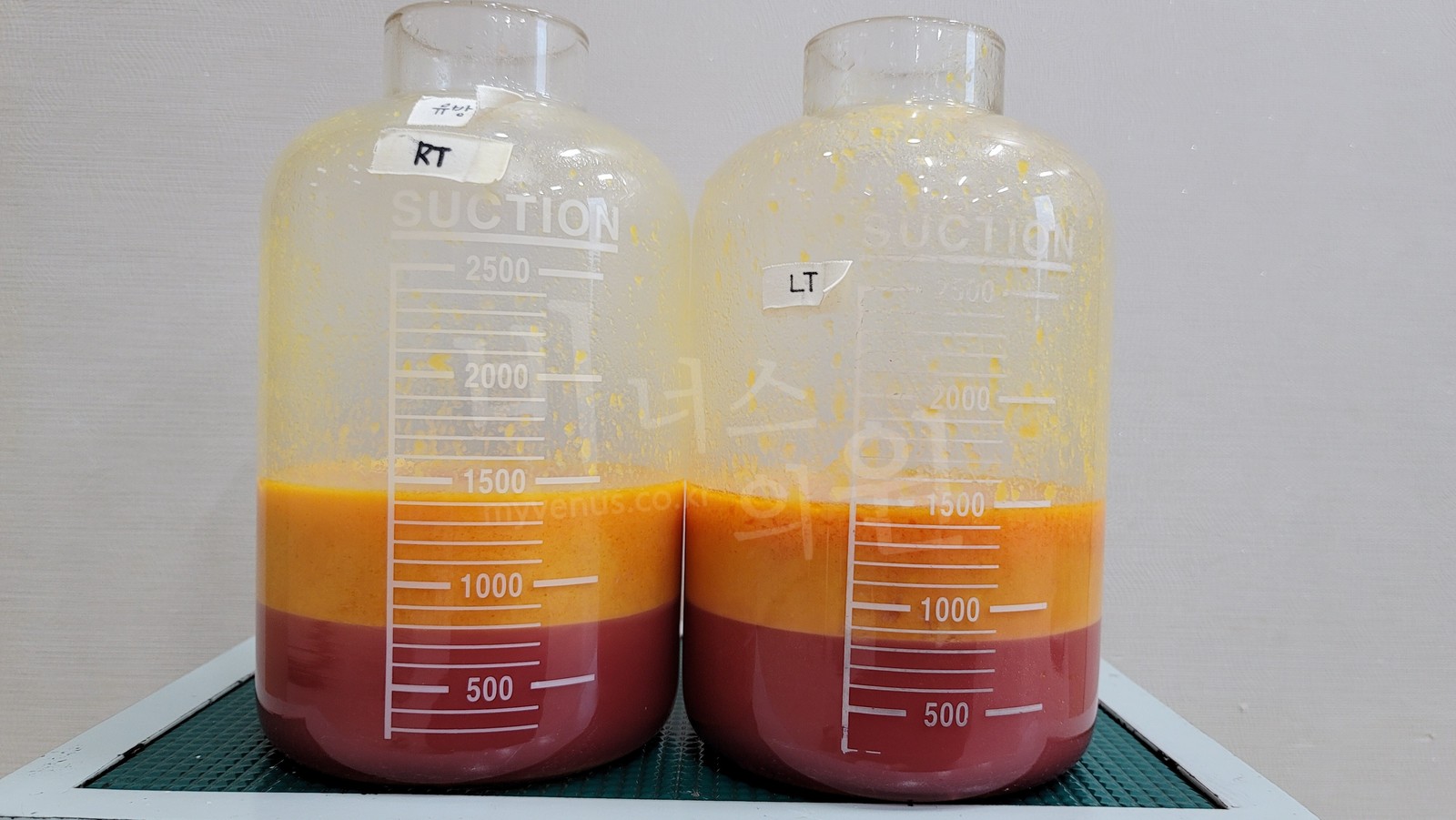 Fat collected in a suction canister by suction-assisted liposuction (SAL), with the fluid layer underneath
