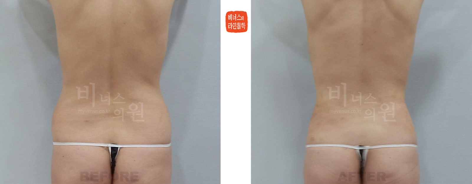 Before and after abdominal liposuction and breast fat grafting, back view (1 week after surgery)