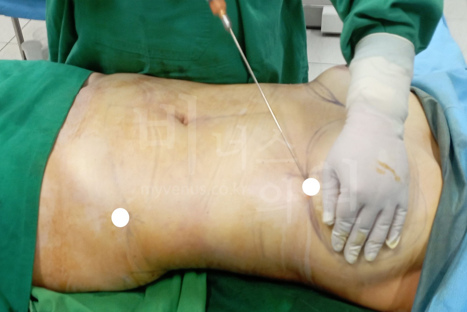 Grafting fat into the breast with a thin cannula