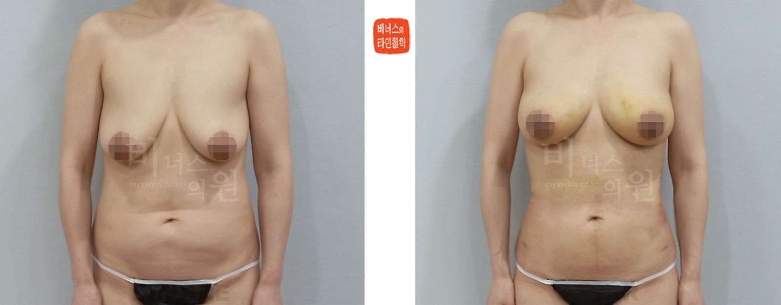 Before and after abdominal liposuction and breast fat grafting, front view (1 week after surgery)