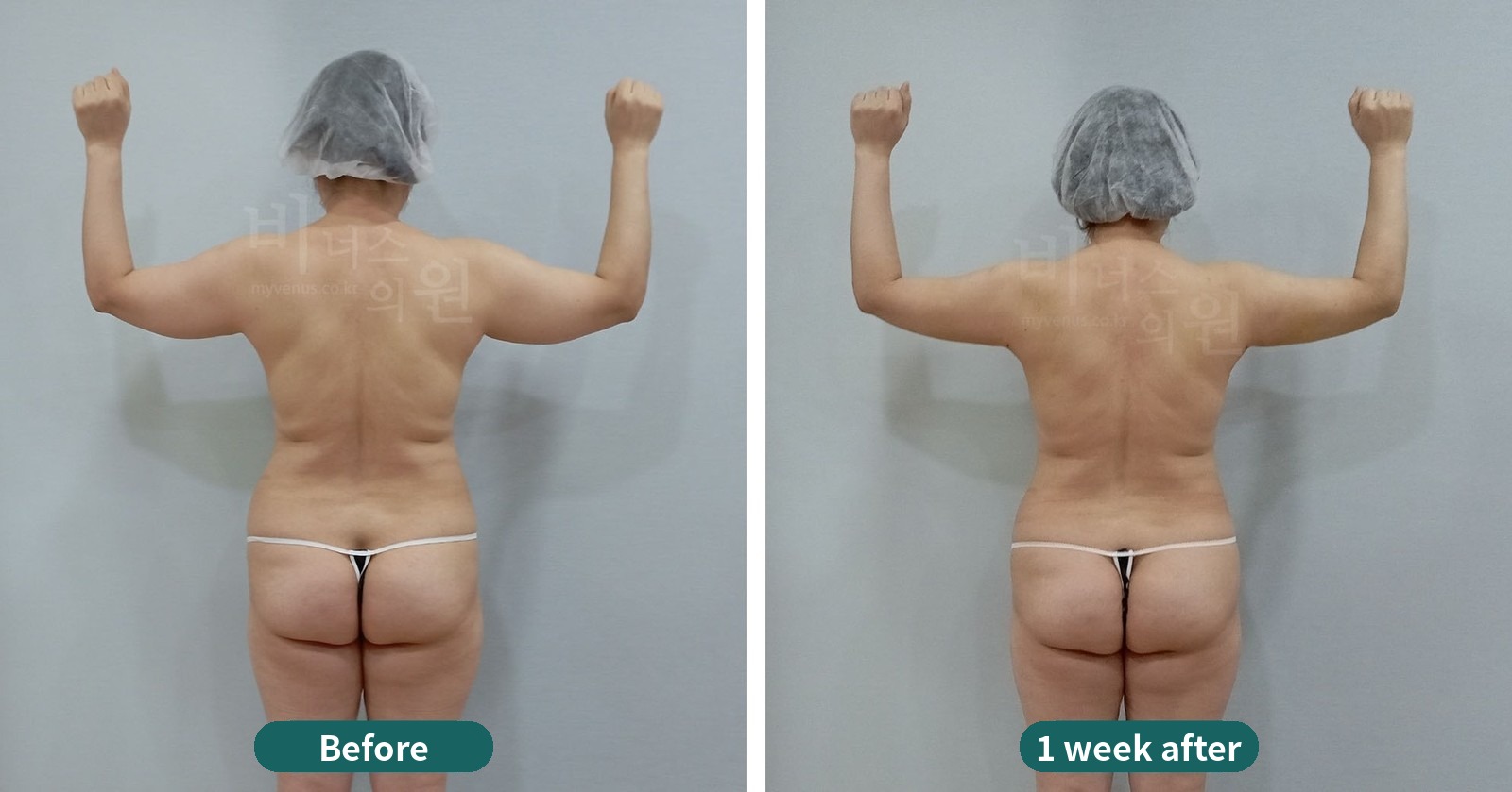 Arm liposuction before-and-after photo, first case: back view with the arm raised (1 week after surgery)