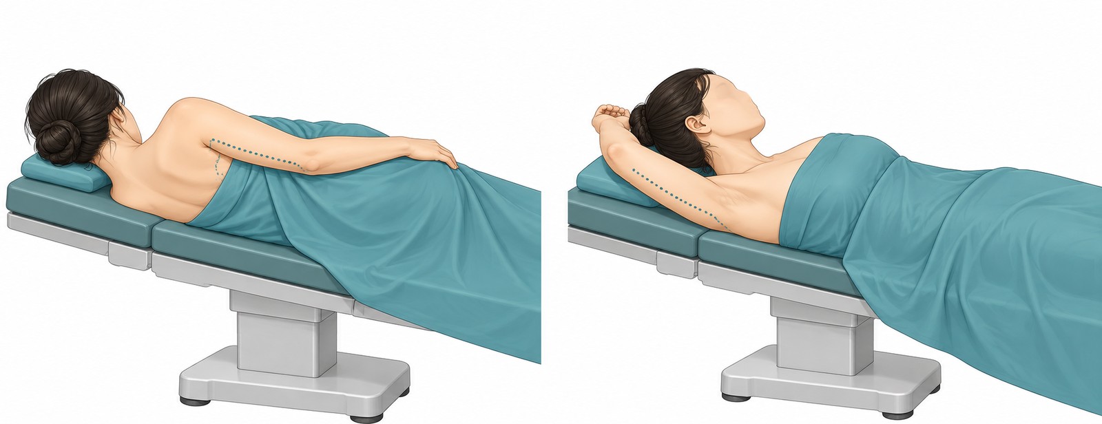 Vector illustration showing the design range of arm liposuction and the two surgical positions
