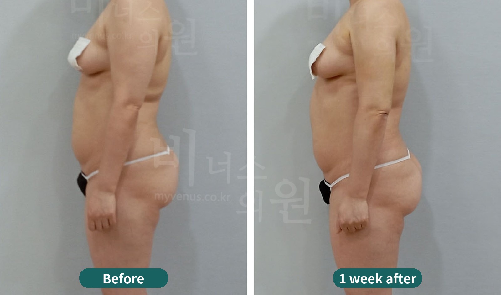 Arm liposuction before-and-after photo, first case: side view with the arm lowered (1 week after surgery)