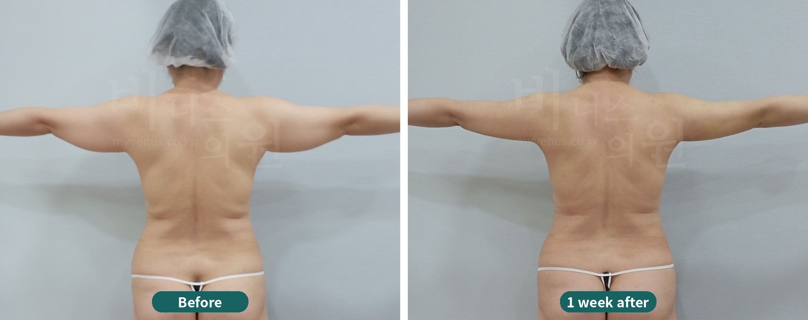 Arm liposuction before-and-after photo, first case: back view with the arm held out to the side (1 week after surgery)