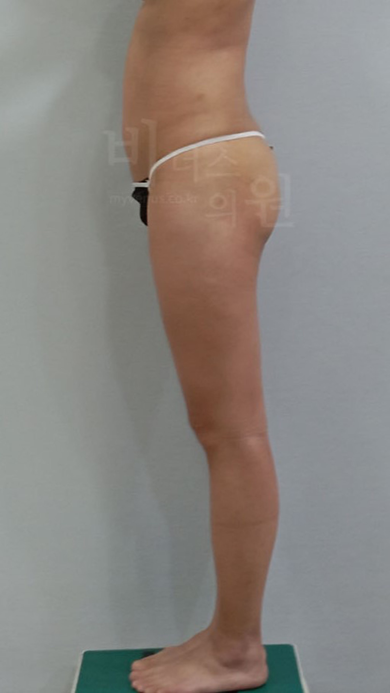 Side view one week after liposuction for buttock ptosis
