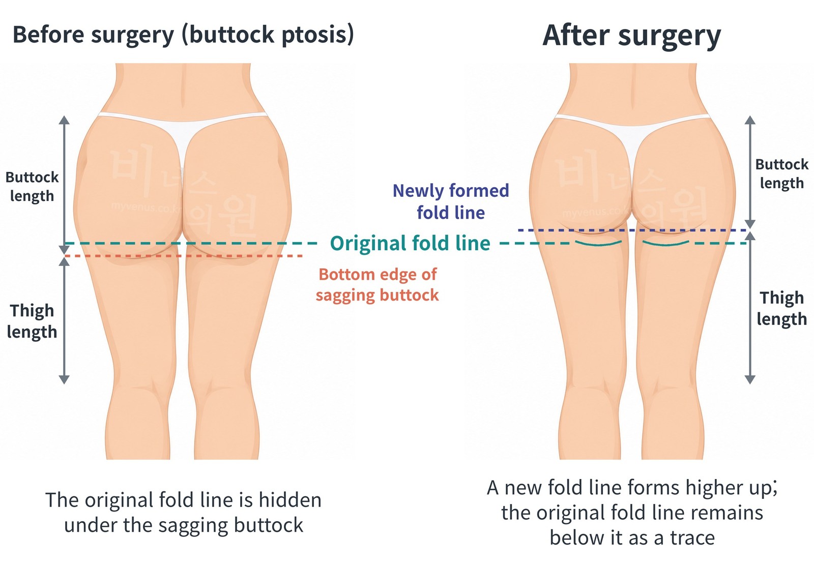 Rear view comparison before and after liposuction for buttock ptosis — after surgery, the newly formed fold line higher up and the original fold line remaining as a trace below it