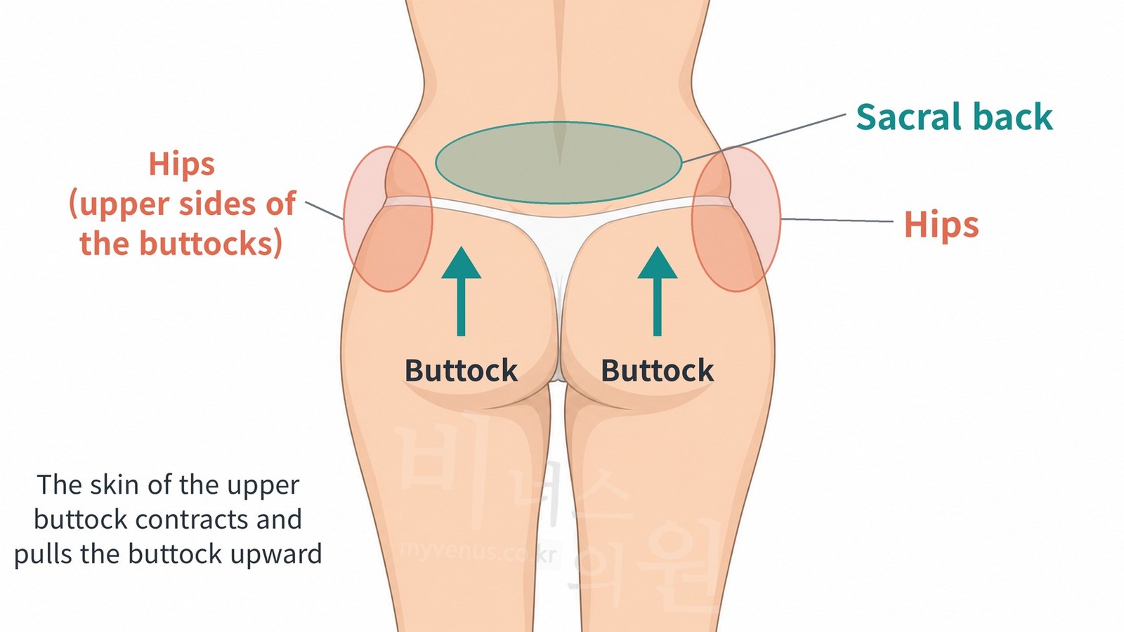 Location of the hips, sacral back, and buttocks seen from behind, and the direction in which the skin contracts and pulls the buttocks upward after liposuction
