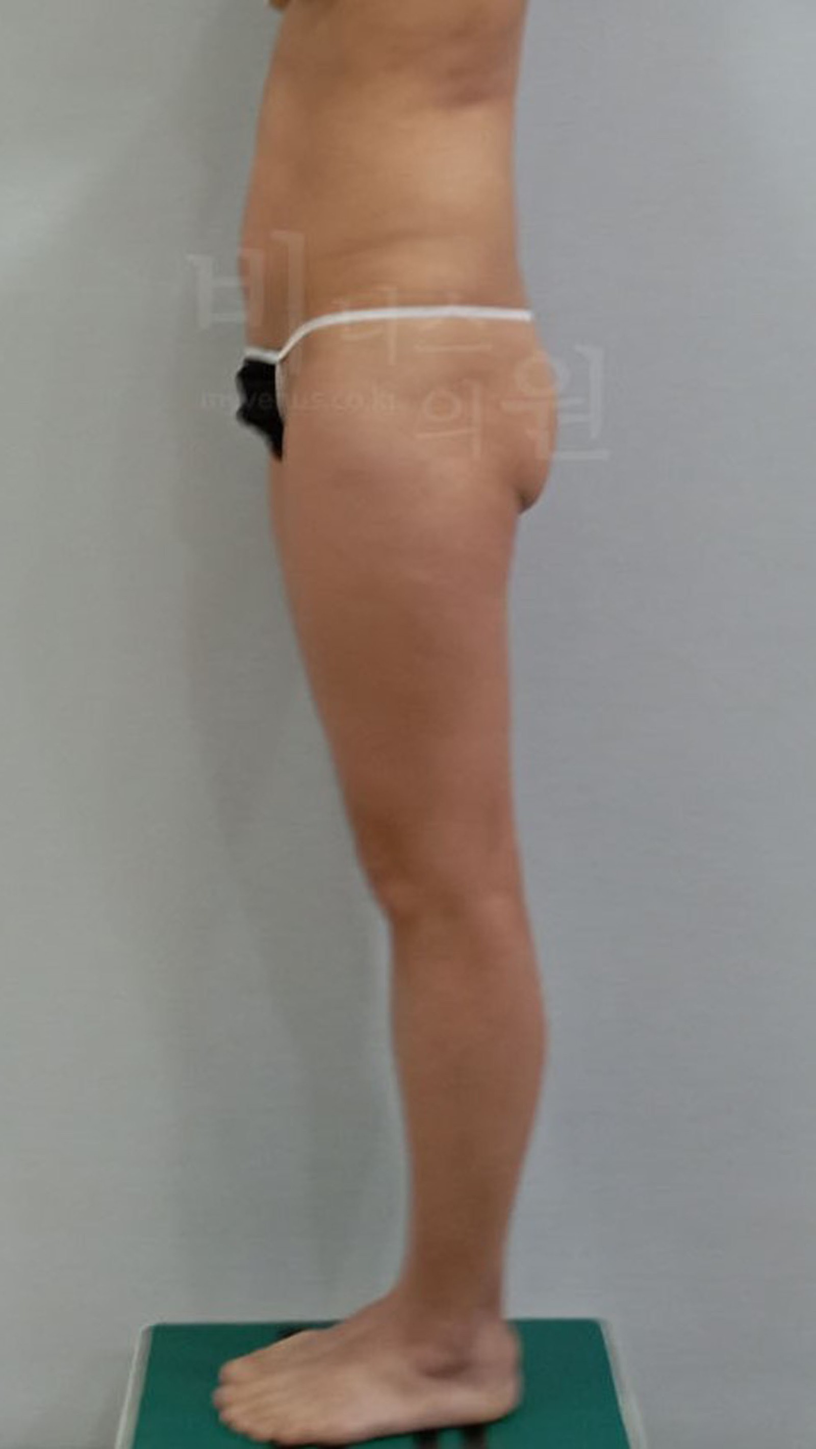 Side view before liposuction for buttock ptosis