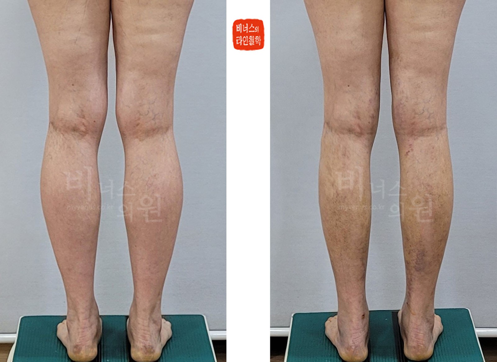 Circumferential calf and medial knee liposuction before-and-after photo, back view with legs together (10 days after surgery)