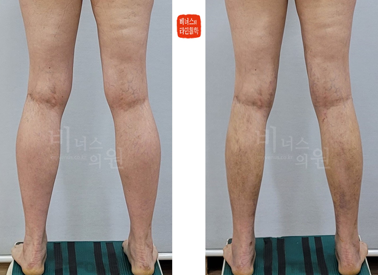 Circumferential calf and medial knee liposuction before-and-after photo, back view with legs apart (10 days after surgery)