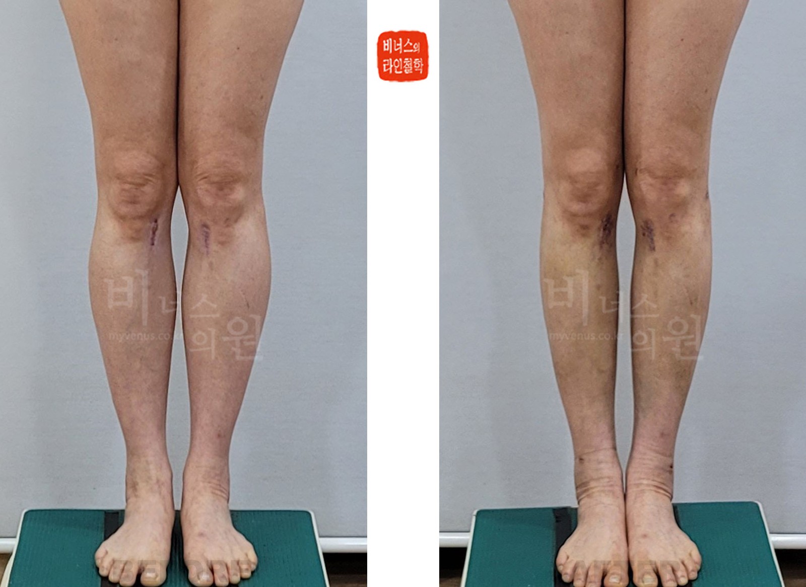 Circumferential calf and medial knee liposuction before-and-after photo, front view with legs together (10 days after surgery)