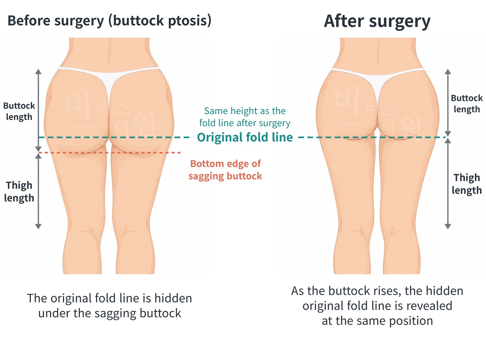 Rear view comparison before and after liposuction for buttock ptosis — a case in which the original fold line that had been hidden by the sagging buttock and the fold line after surgery are at the same height