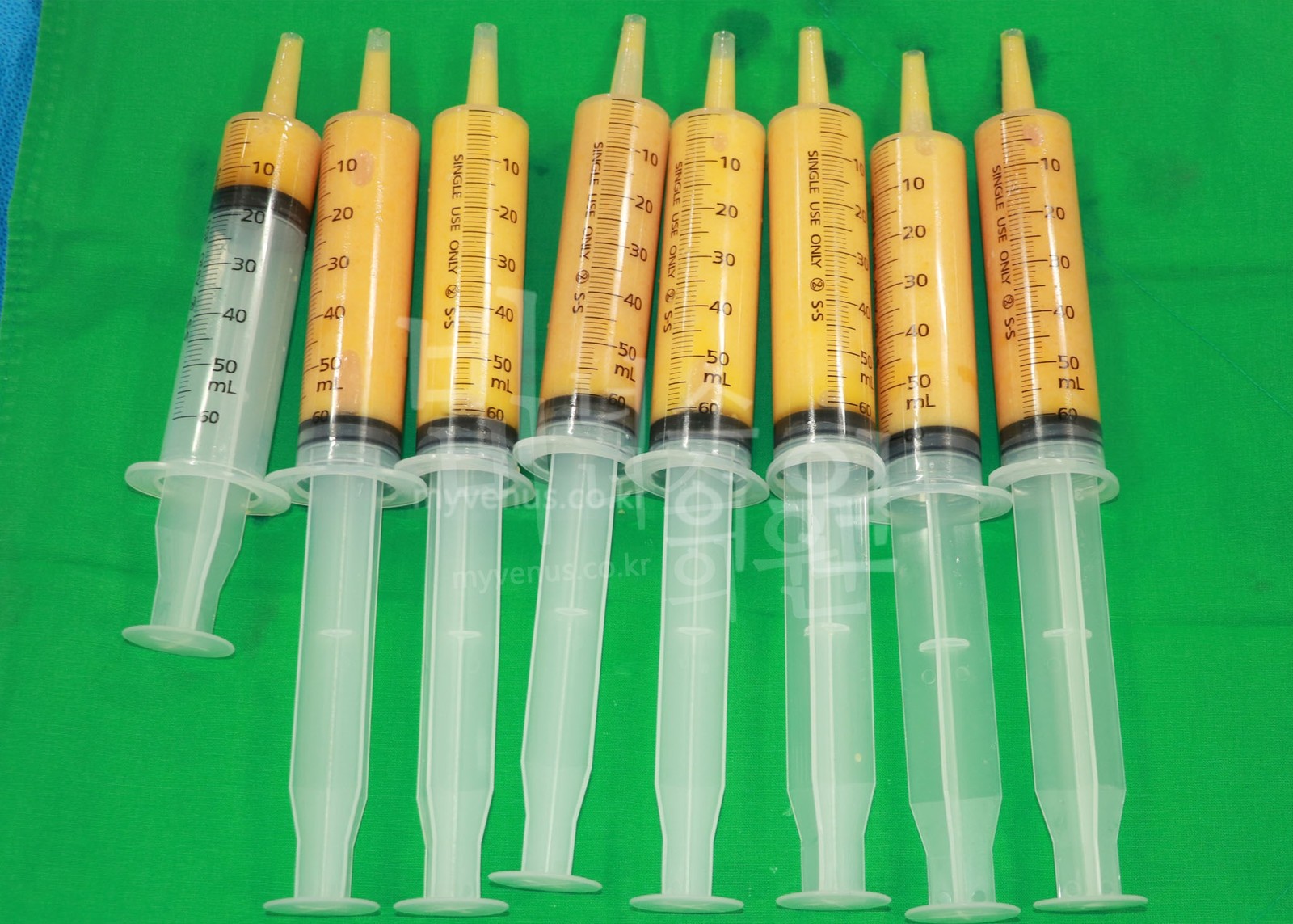 Fat removed by syringe liposuction