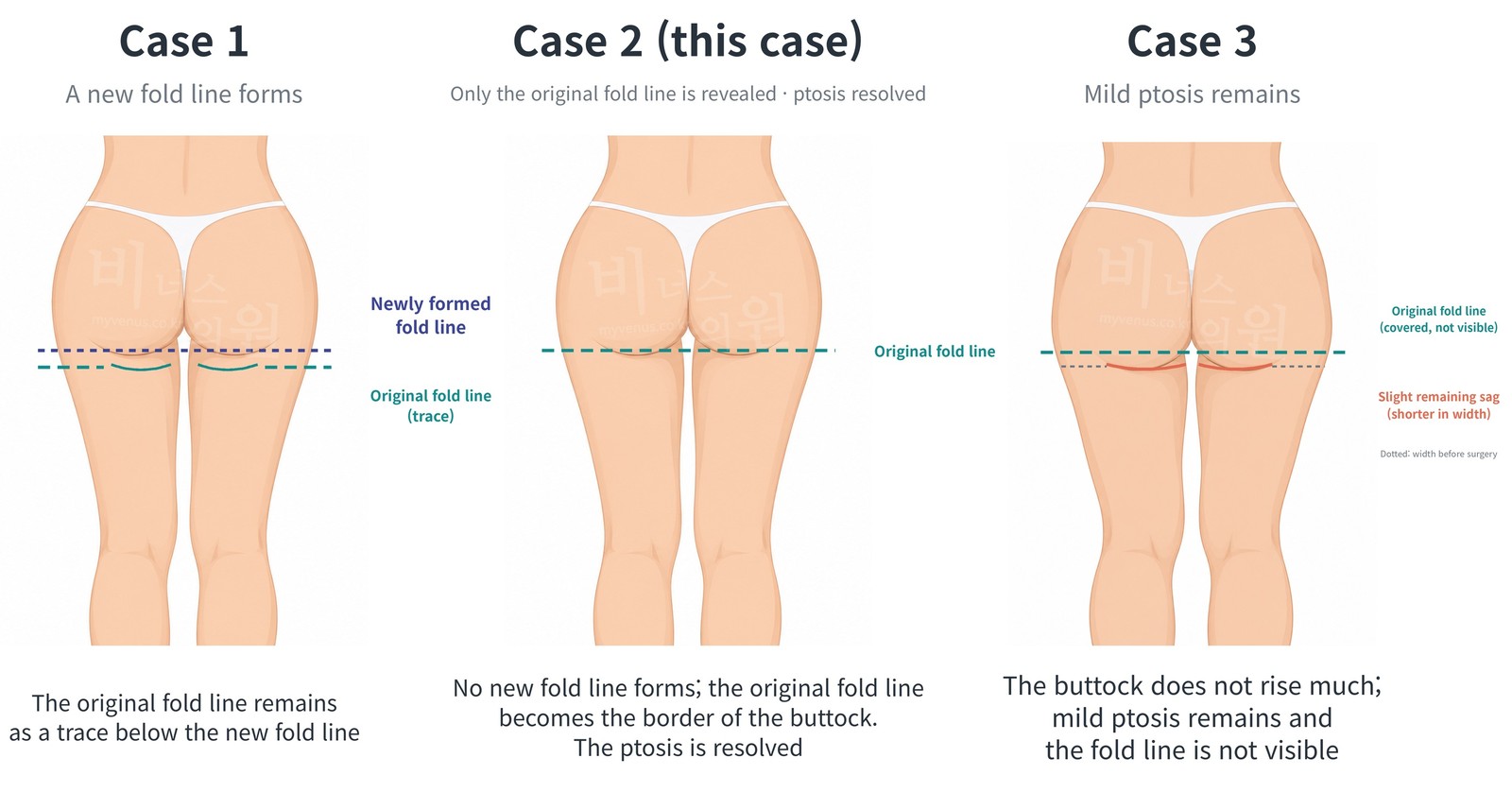 Comparison of three appearances of the fold line after surgery — Case 1, a new fold line forms; Case 2, only the original fold line is revealed; Case 3, mild ptosis remains