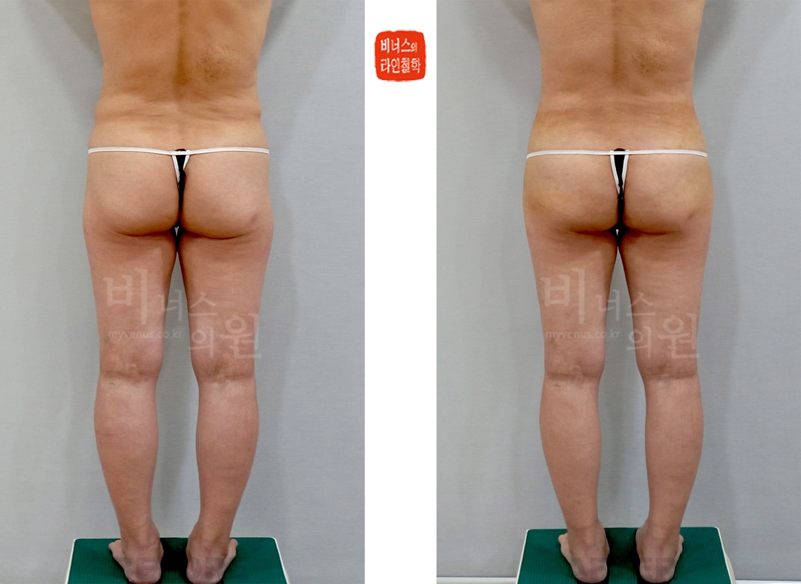 Before-and-after photos of liposuction for buttock ptosis, rear view with legs together (one week after surgery)