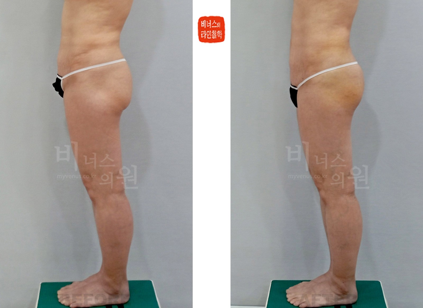 Before-and-after photos of liposuction for buttock ptosis, opposite side view (one week after surgery)