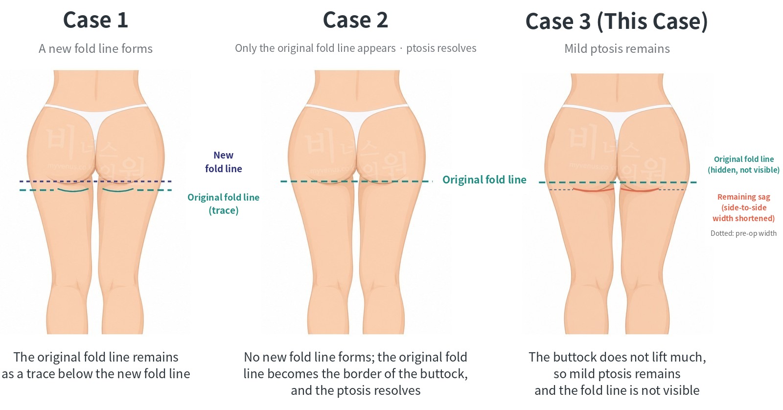 Comparison of the three ways the fold line appears after liposuction for buttock ptosis — this patient is Case 3