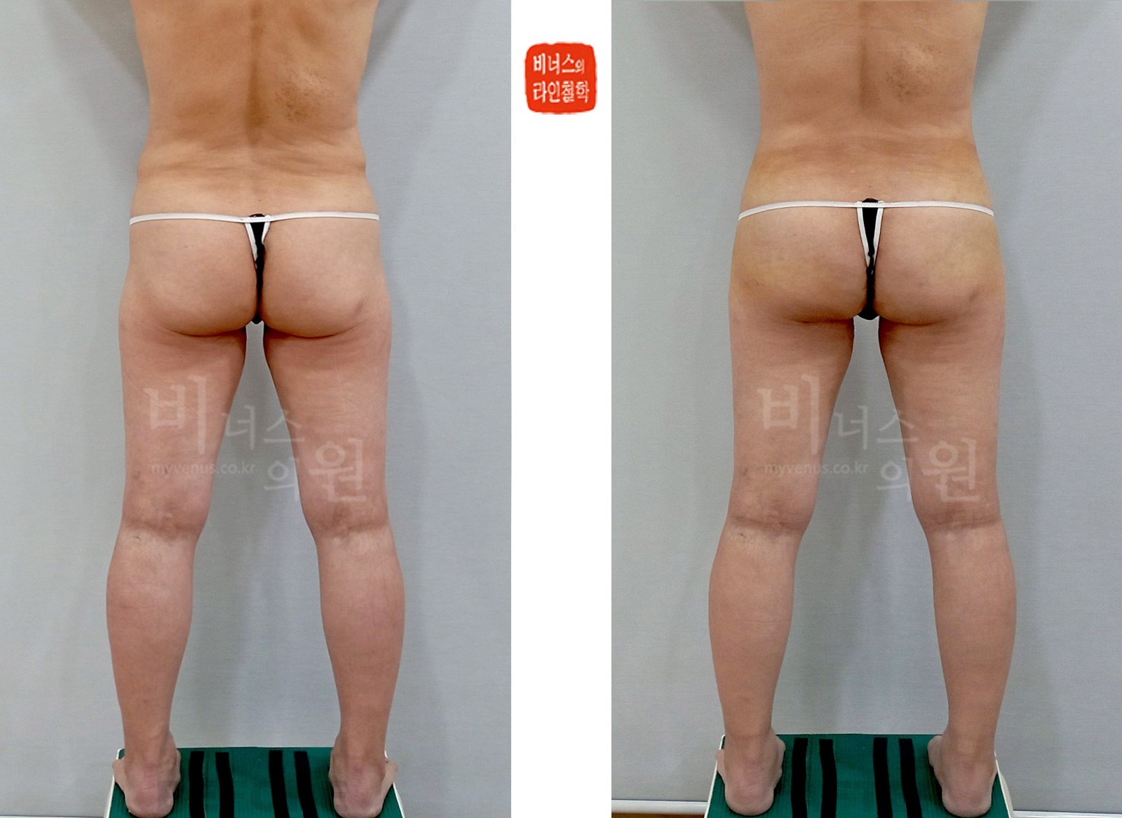Before-and-after photos of liposuction for buttock ptosis, rear view with legs apart (one week after surgery)